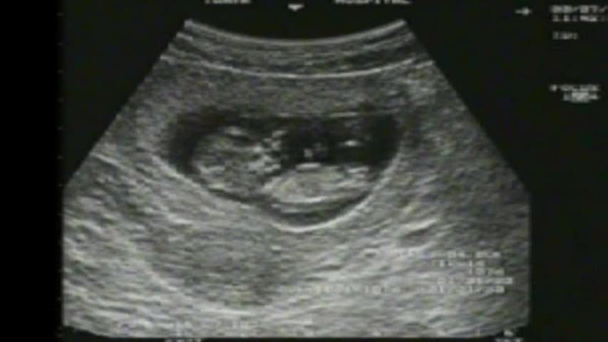 ultrasound images of girls and boys.  that the penis is the most prominent diffrence between boys and girls.